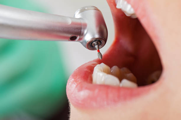 Best Emergency Dentist for Lost Fillings or Crowns in Ashland, NJ